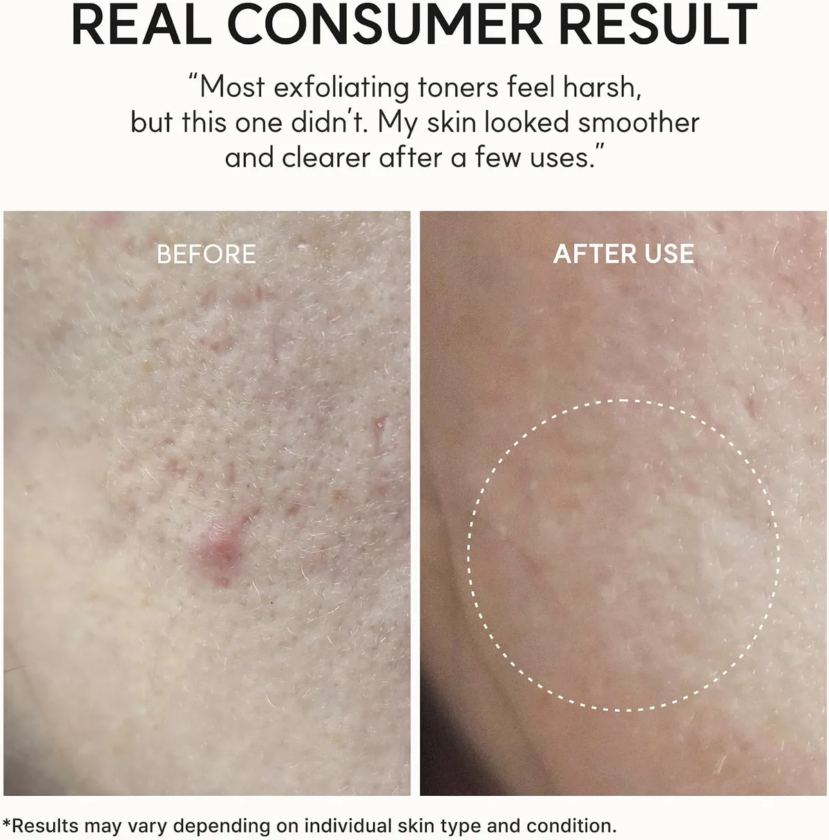 Arencia - Eraser Shot Glycolic Acid Exfoliator - Exfoliant chimique – صورة 6